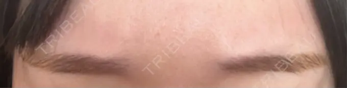 ボトックス（眉間） / ボトックス（額） ルラ美容クリニック 池袋院 AFTER メイン用