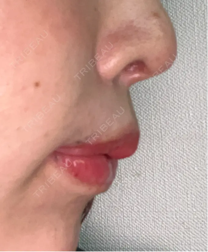 人中短縮 / 口角挙上 / その他（口元） R Beauty CLINIC 銀座院 DAY 25 メイン用