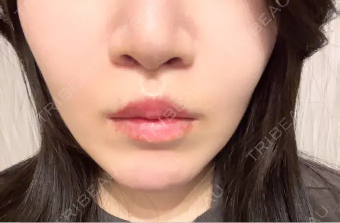 人中短縮 / 鼻柱下降・鼻唇角形成（猫手術） / その他（鼻） Otus Clinic 【オータスクリニック】 AFTER メイン用