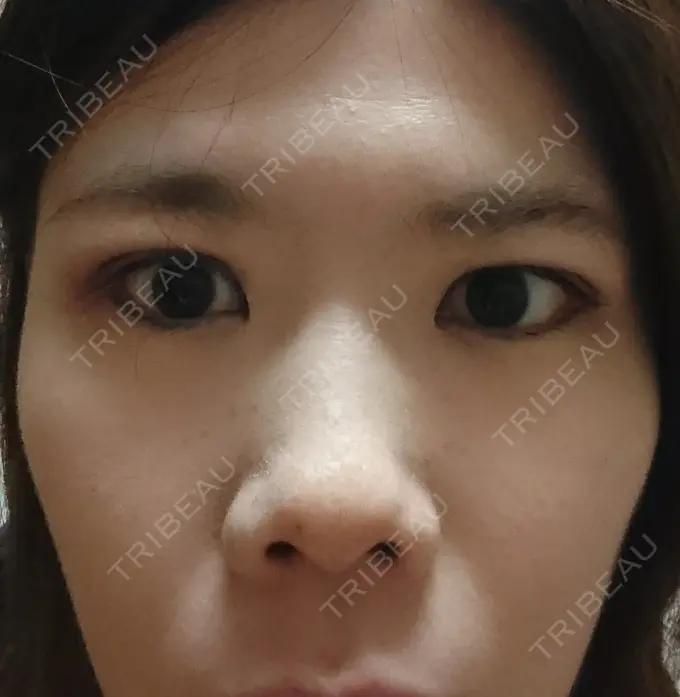 二重埋没 湘南美容クリニック 鹿児島院 DAY 3 メイン用