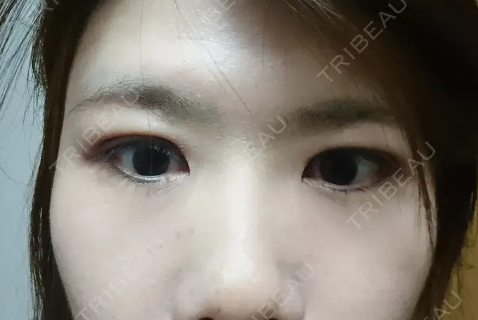 二重埋没 湘南美容クリニック 鹿児島院 DAY 4 メイン用