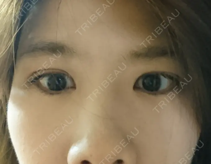 二重埋没 湘南美容クリニック 鹿児島院 DAY 5 メイン用