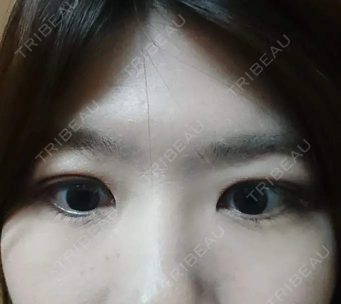 二重埋没 湘南美容クリニック 鹿児島院 DAY 6 メイン用