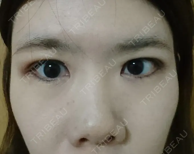 二重埋没 湘南美容クリニック 鹿児島院 DAY 7 メイン用