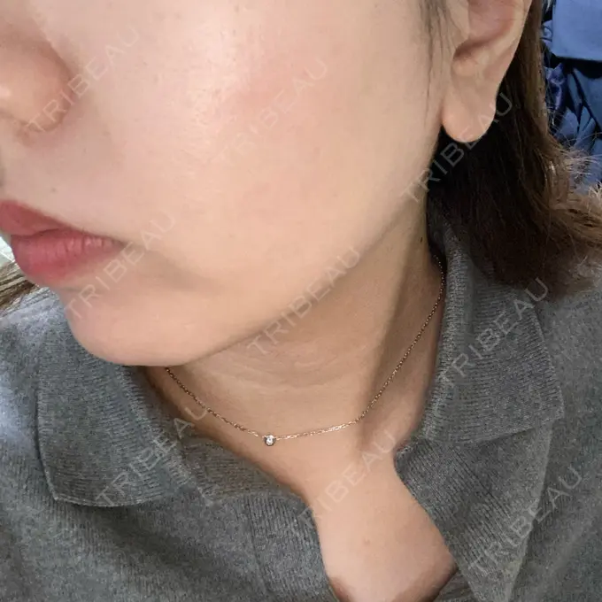 RF（高周波）たるみ治療 表参道メディカルクリニック 表参道院 DAY 6 メイン用