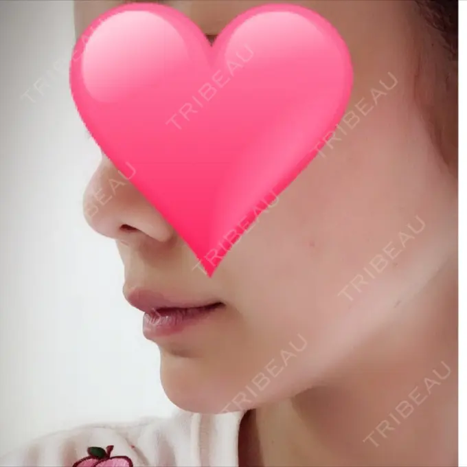 あごプロテーゼ ジュエリー美容外科 DAY 32 メイン用