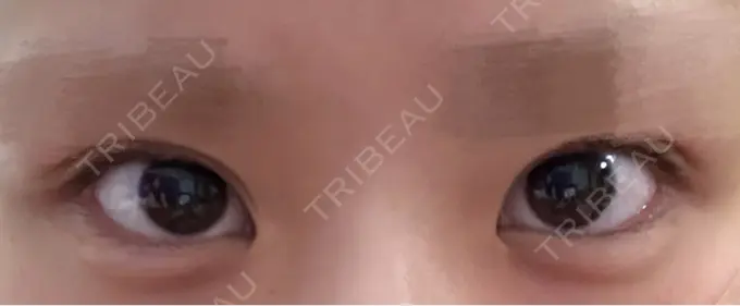 ヒアルロン酸注入（涙袋） フィラークリニック 渋谷院 AFTER メイン用