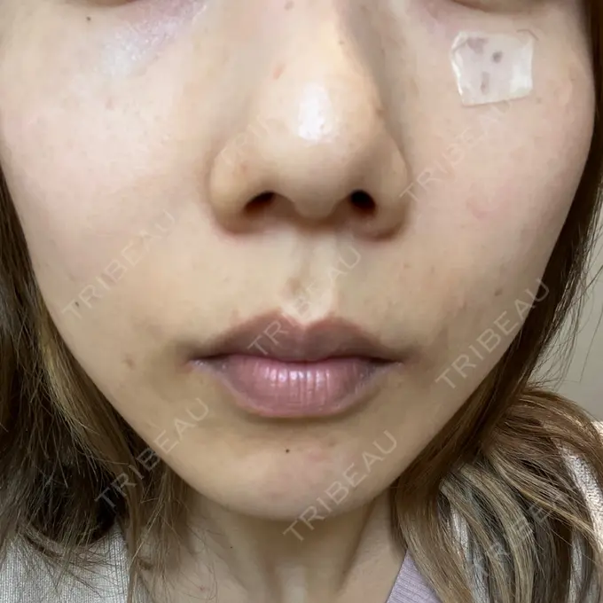 ピコスポット 東京シルククリニック 新宿院 DAY 8 メイン用