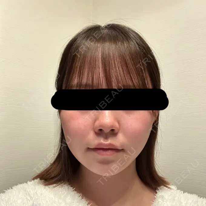 脂肪吸引（顔） / 脂肪吸引注射（顔） SEA CLINIC（シークリニック） DAY 106 メイン用