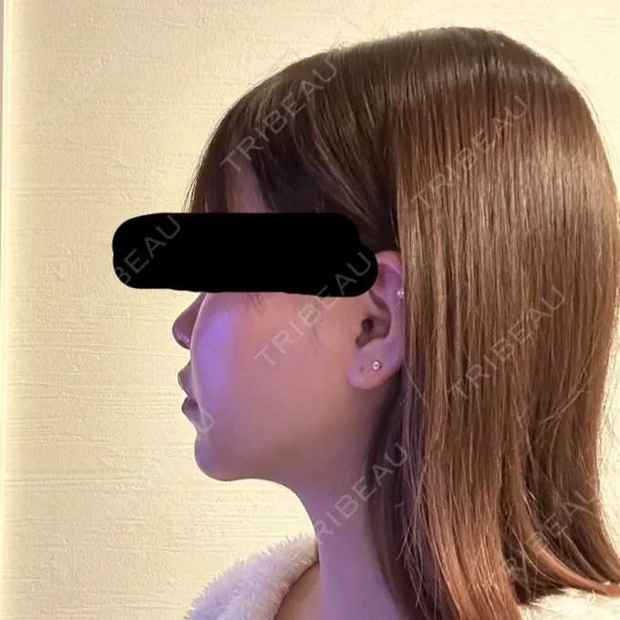 脂肪吸引（顔） / 脂肪吸引注射（顔） SEA CLINIC（シークリニック） DAY 106 メイン用