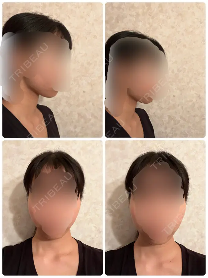 脂肪吸引（顔） / 脂肪吸引（脚） Mods Clinic（モッズクリニック） 名古屋院 DAY 89 メイン用