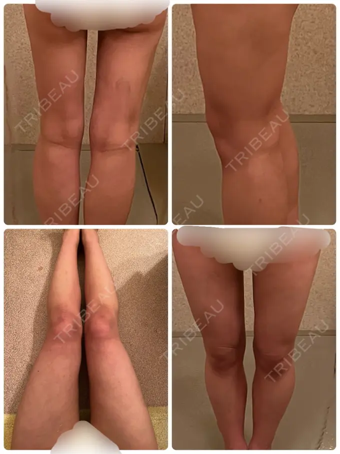 脂肪吸引（顔） / 脂肪吸引（脚） Mods Clinic（モッズクリニック） 名古屋院 DAY 89 メイン用