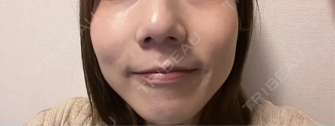 ピコスポット 東京シルククリニック 新宿院 AFTER メイン用