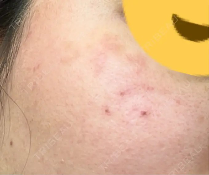 ピコスポット アマリラビューティークリニック DAY 6 メイン用