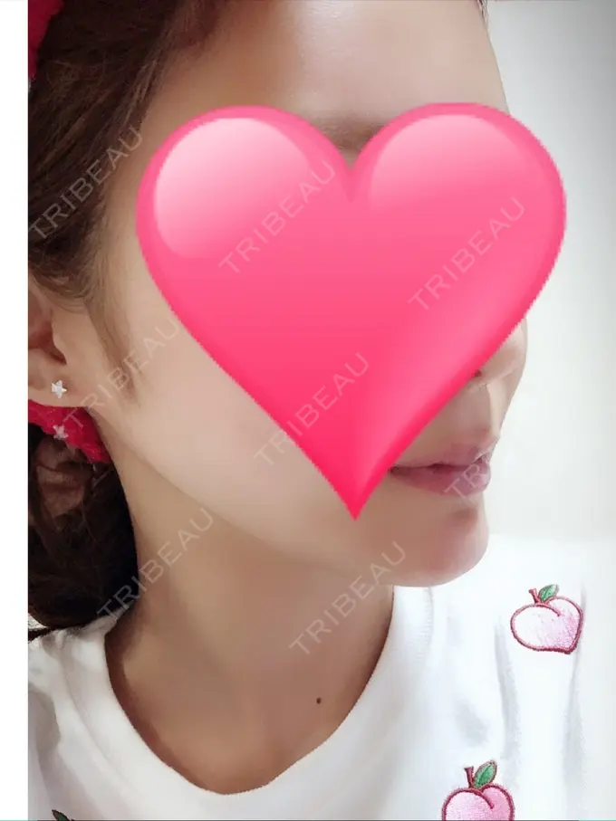 あごプロテーゼ ジュエリー美容外科 DAY 32 メイン用