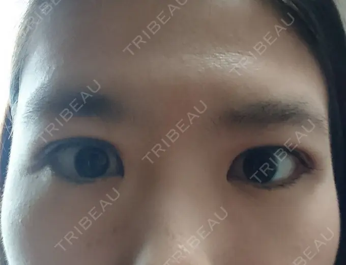 二重埋没 湘南美容クリニック 鹿児島院 DAY 9 メイン用