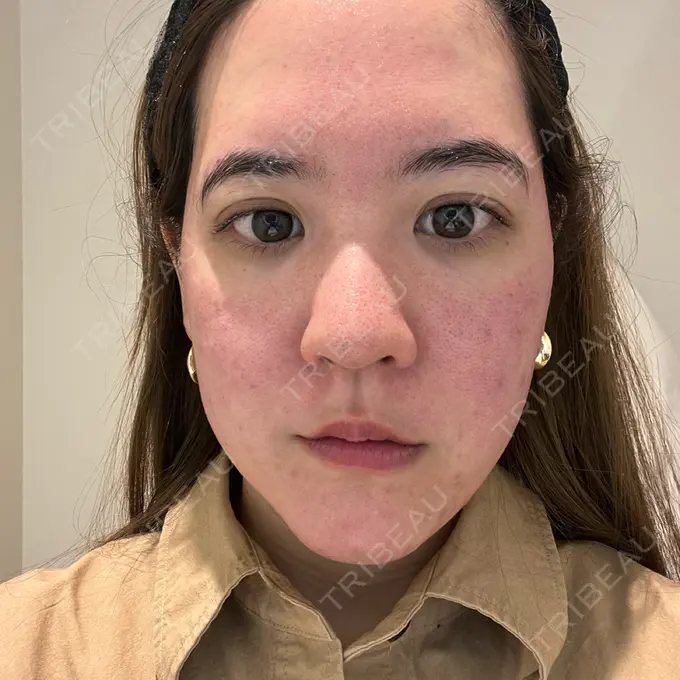 美肌レーザー / 美白レーザー / 光治療（フォトフェイシャルなど） / YAGレーザー / レーザーフェイシャル / 赤み除去レーザー AI Beauty Clinic （エーアイ美容クリニック） AFTER メイン用