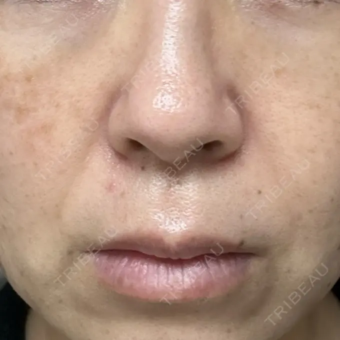 ピコレーザートーニング（美白・肝斑） / ピコフラクショナルレーザー（毛穴・ニキビ跡） ルラ美容クリニック 仙台院 / ルラスキンクリニック 仙台院 AFTER メイン用