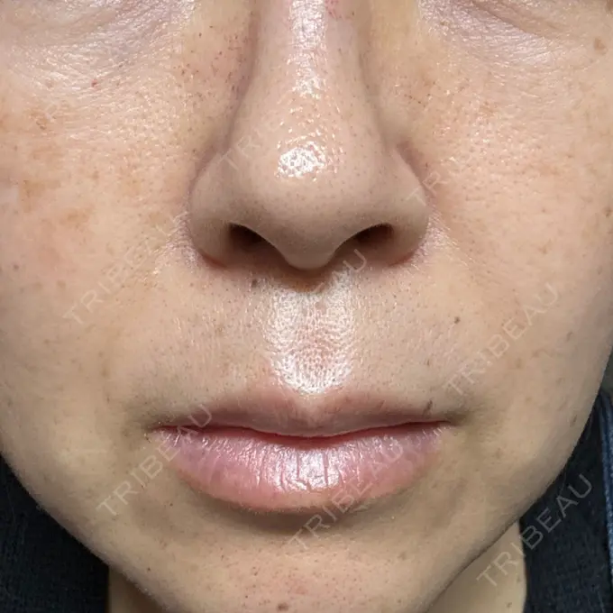 ピコレーザートーニング（美白・肝斑） / ピコフラクショナルレーザー（毛穴・ニキビ跡） ルラ美容クリニック 仙台院 / ルラスキンクリニック 仙台院 DAY 0 メイン用