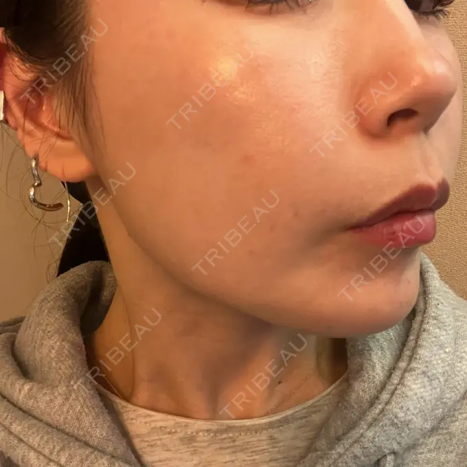 ルメッカ 大美会クリニック 心斎橋本院 AFTER メイン用