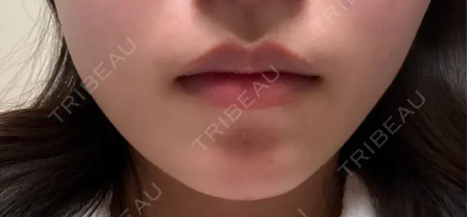 ボトックス（エラ・小顔） 共立美容外科 千葉院 DAY 17 メイン用