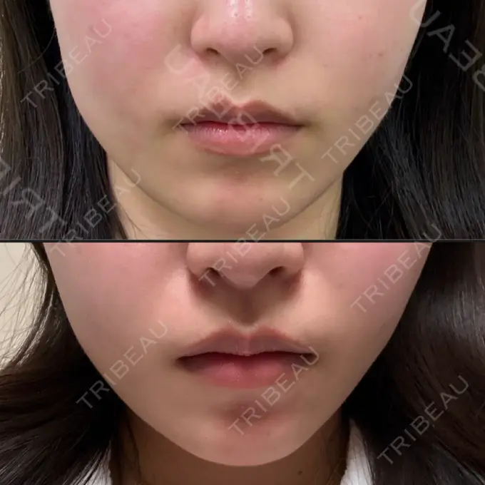 ボトックス（エラ・小顔） 共立美容外科 千葉院 DAY 17 メイン用