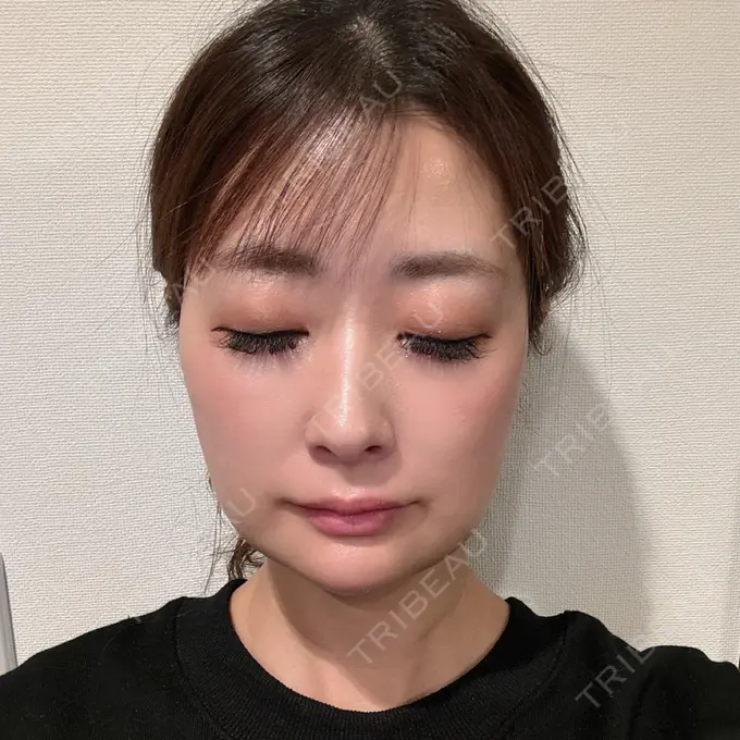 糸リフト / ジョールファット除去 / 脂肪吸引注射（顔） / ボトックス（エラ・小顔） / 脂肪注入（輪郭） ICON CLINIC DAY 9 メイン用