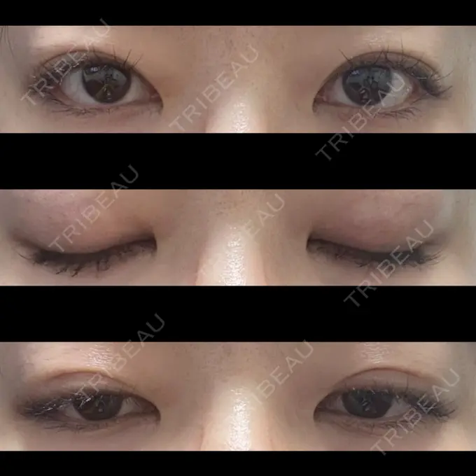 二重埋没 水の森美容クリニック 東京銀座院 DAY 17 メイン用