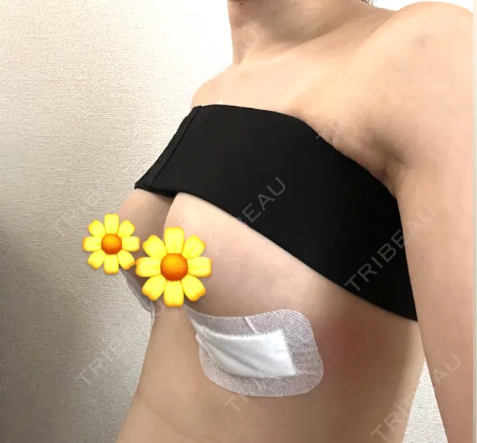 豊胸（シリコンバッグ） Code Beauty Clinic 名古屋院 DAY 48 メイン用