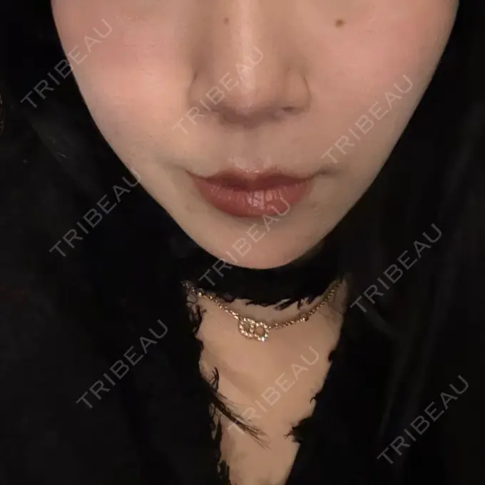 人中短縮 / 鼻翼挙上 / 鼻尖縮小 Otus Clinic 【オータスクリニック】 DAY 167 メイン用