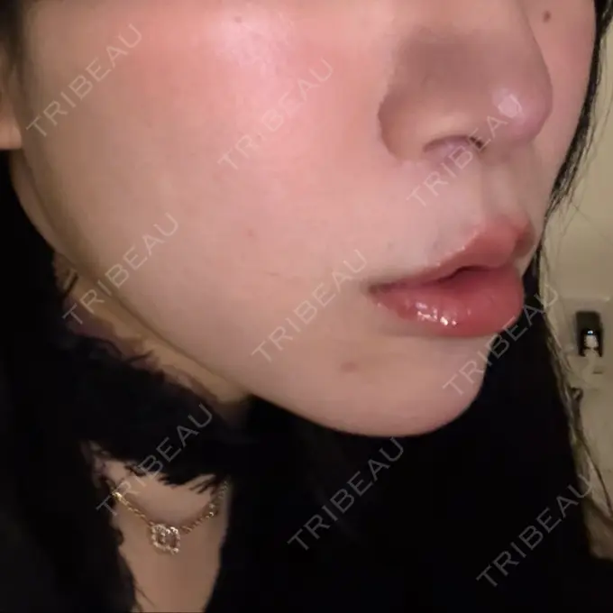 人中短縮 / 鼻翼挙上 / 鼻尖縮小 Otus Clinic 【オータスクリニック】 DAY 167 メイン用