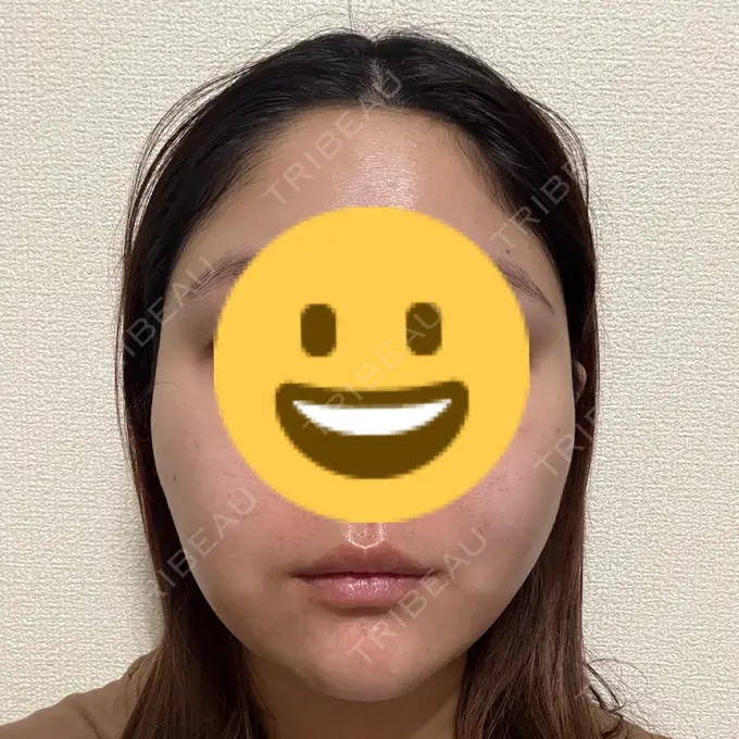 糸リフト / ボトックス（エラ・小顔） TCB東京中央美容外科 千葉駅前院 DAY 3 メイン用