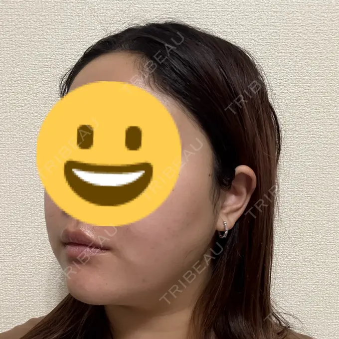 糸リフト / ボトックス（エラ・小顔） TCB東京中央美容外科 千葉駅前院 DAY 3 メイン用