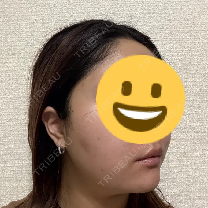 糸リフト / ボトックス（エラ・小顔） TCB東京中央美容外科 千葉駅前院 DAY 3 メイン用