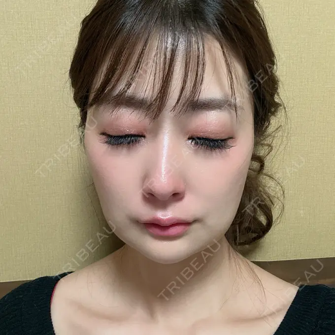 糸リフト / ジョールファット除去 / 脂肪吸引注射（顔） / ボトックス（エラ・小顔） / 脂肪注入（輪郭） ICON CLINIC DAY 11 メイン用