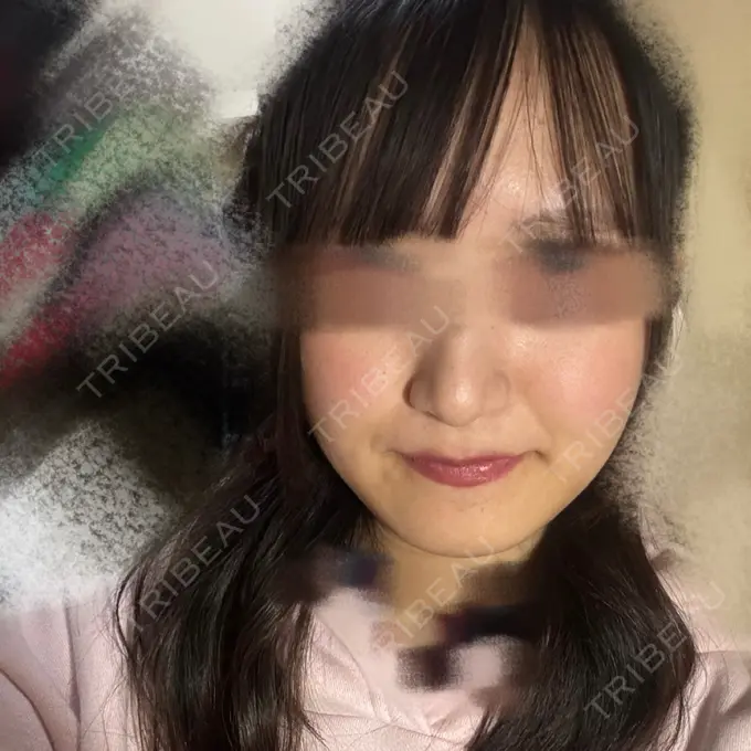 骨切り（あご） 銀座マイアミ美容外科 DAY 315 メイン用