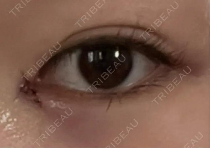 目頭切開 東京シンデレラ美容外科 池袋院 DAY 0 メイン用