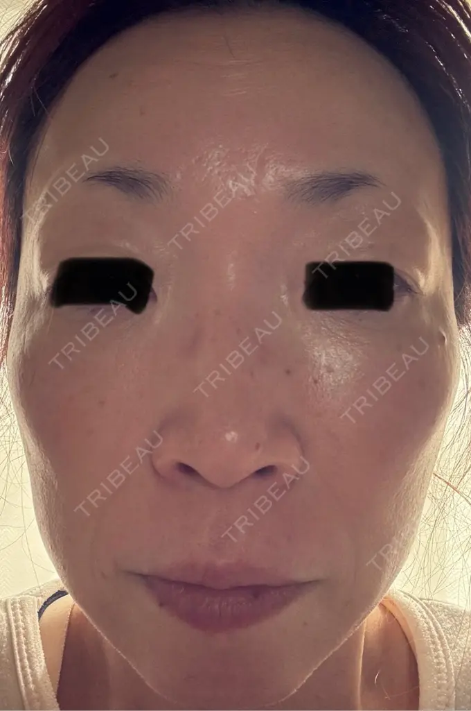 ピーリング（ハリ・ツヤ） 椿クリニック 名古屋院 DAY 4 メイン用