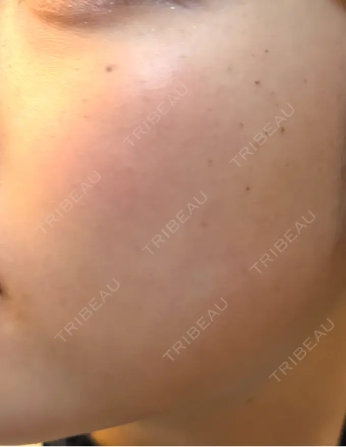 エレクトロポレーション / ルメッカ ゆきスキンクリニック 東池袋 DAY 9 メイン用