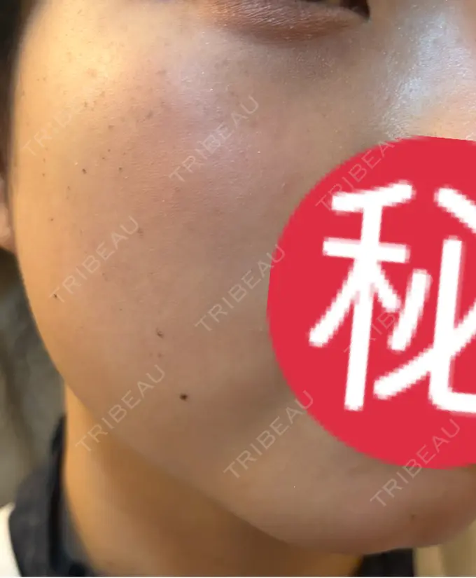 エレクトロポレーション / ルメッカ ゆきスキンクリニック 東池袋 DAY 9 メイン用