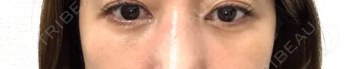 クマ治療 / 下まぶたの脂肪取り / ヒアルロン酸注入（目の下） / その他（目元） ROOTS Clinic AFTER メイン用