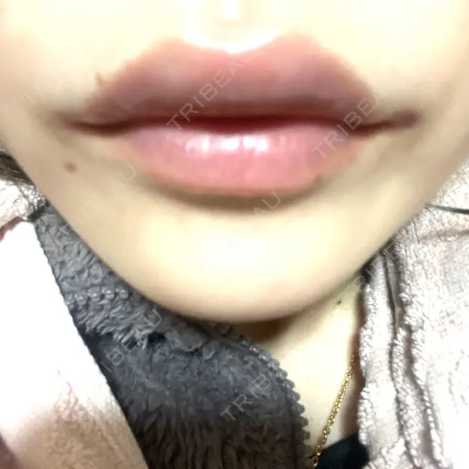 ヒアルロン酸注入（涙袋） / ボトックス（エラ・小顔） / ヒアルロン酸注入（唇） 東京シンデレラ美容外科 池袋院 DAY 0 メイン用