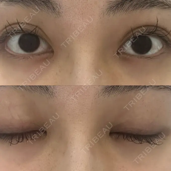 二重埋没 / クマ治療 ASTRA BEAUTY CLINIC AFTER メイン用