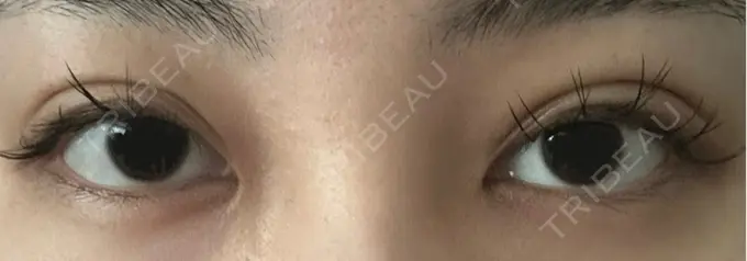 二重埋没 / クマ治療 ASTRA BEAUTY CLINIC DAY 779 メイン用