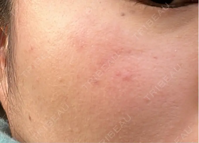 ピコスポット アマリラビューティークリニック DAY 9 メイン用