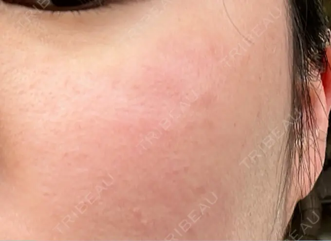 ピコスポット アマリラビューティークリニック DAY 9 メイン用