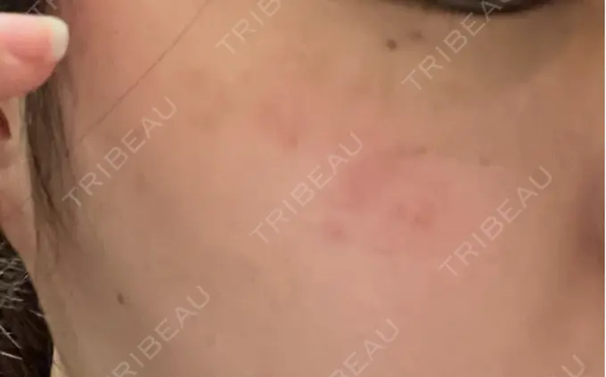 ピコスポット アマリラビューティークリニック DAY 8 メイン用