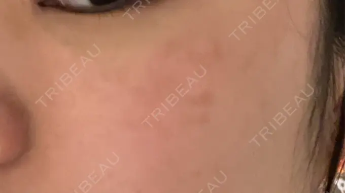 ピコスポット アマリラビューティークリニック DAY 8 メイン用