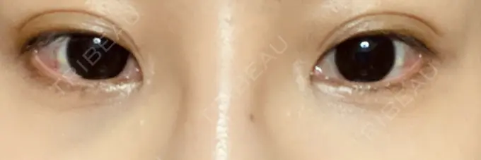 ヒアルロン酸溶解 麻布十番クレールデンタルクリニック DAY 21 メイン用