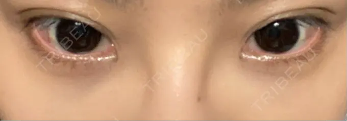 ヒアルロン酸溶解 麻布十番クレールデンタルクリニック DAY 23 メイン用